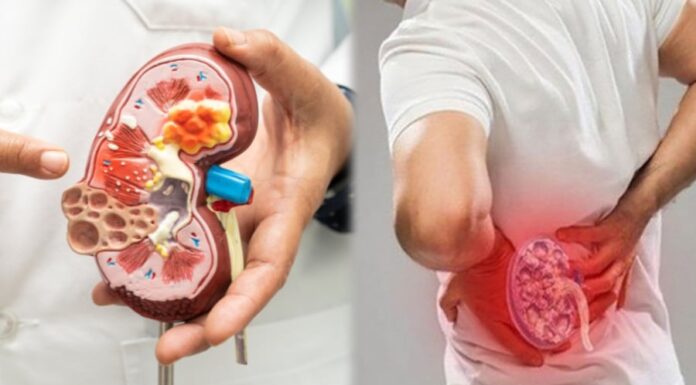 5 Warning Signs Your Kidneys Are in Danger – Time to See a Doctor