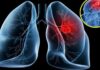 9 Early Warning Signs of Lung Cancer You Shouldn’t Ignore