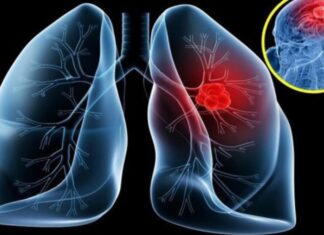 9 Early Warning Signs of Lung Cancer You Shouldn’t Ignore