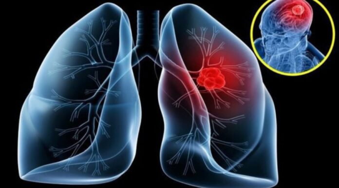 9 Early Warning Signs of Lung Cancer You Shouldn’t Ignore