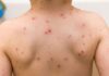 How to Tell if Your Child Has Measles, Chickenpox, or an Allergic Reaction by Sight Alone?