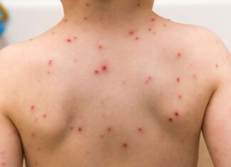 How to Tell if Your Child Has Measles, Chickenpox, or an Allergic Reaction by Sight Alone?