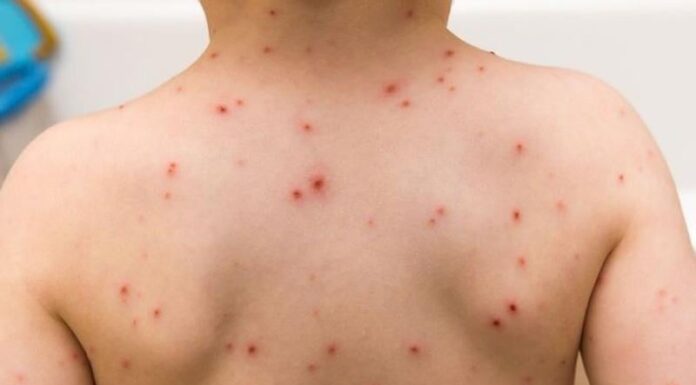 How to Tell if Your Child Has Measles, Chickenpox, or an Allergic Reaction by Sight Alone?