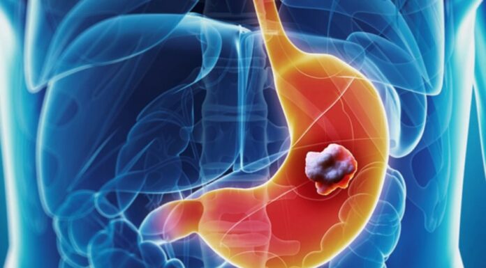 7 Early Warning Signs of Stomach Cancer That You Shouldn’t Ignore