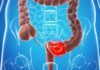 “Beware: These 4 Foods Could Increase Your Risk of Colon Cancer”