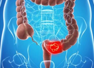 “Beware: These 4 Foods Could Increase Your Risk of Colon Cancer”