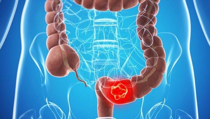 “Beware: These 4 Foods Could Increase Your Risk of Colon Cancer”
