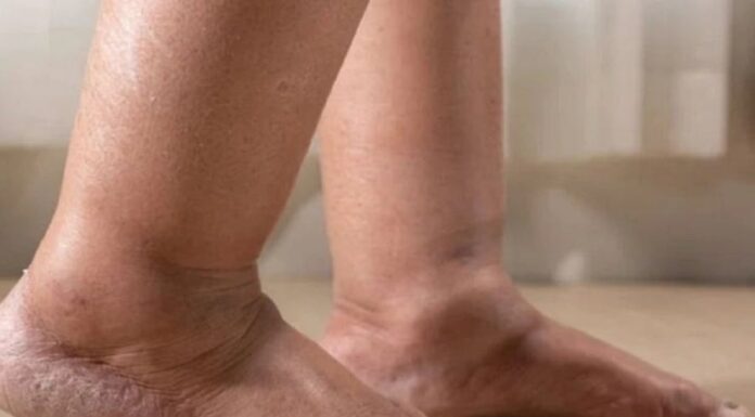 “3 Foot Symptoms That Could Be Warning Signs of Lung Cancer”