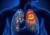 The Secret Killer: Uncover the Leading Cause of Lung Cancer in Vietnamese Men