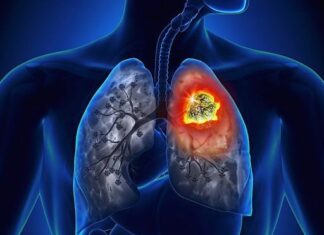 The Secret Killer: Uncover the Leading Cause of Lung Cancer in Vietnamese Men