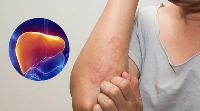 7 Warning Signs Your Liver Disease Has Progressed to an Advanced Stage