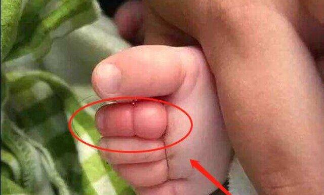 A Father’s Swim Session With His 2-Year-Old Takes a Shocking Turn: A Tale of a Swollen, Red Toe