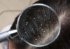 “Dandruff Persists Despite Anti-Dandruff Shampoo? You May Be Making This Common Mistake.”