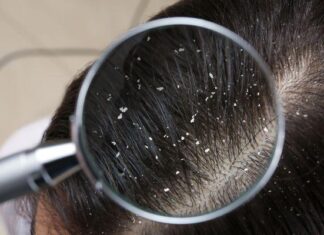 “Dandruff Persists Despite Anti-Dandruff Shampoo? You May Be Making This Common Mistake.”