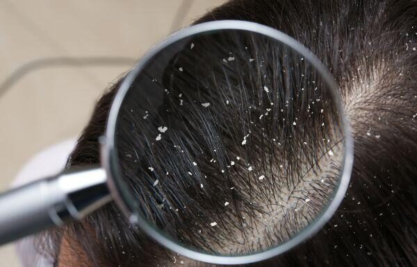 “Dandruff Persists Despite Anti-Dandruff Shampoo? You May Be Making This Common Mistake.”