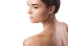 “Don’t Let Keloids Get You Down: MPS in Hiruscar Silicone Pro to the Rescue”
