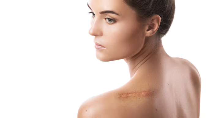 “Don’t Let Keloids Get You Down: MPS in Hiruscar Silicone Pro to the Rescue”