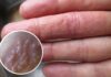 Is It Normal to Have Tiny Blisters on Your Hand?