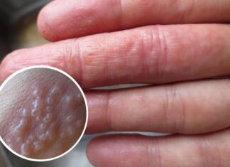 Is It Normal to Have Tiny Blisters on Your Hand?