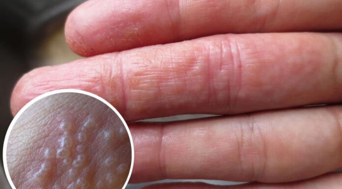 Is It Normal to Have Tiny Blisters on Your Hand?