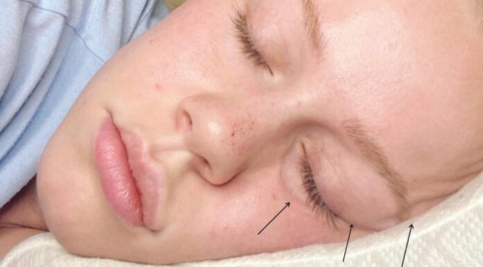 A Good Night’s Rest or a Wrinkle’s Worst: The Impact of Sleep Positions on Skin Aging