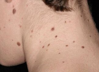 5 Small Skin Changes That Could Be Warning Signs