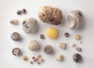 5 Key Differences Between Gallstones and Kidney Stones: Which is More Serious?