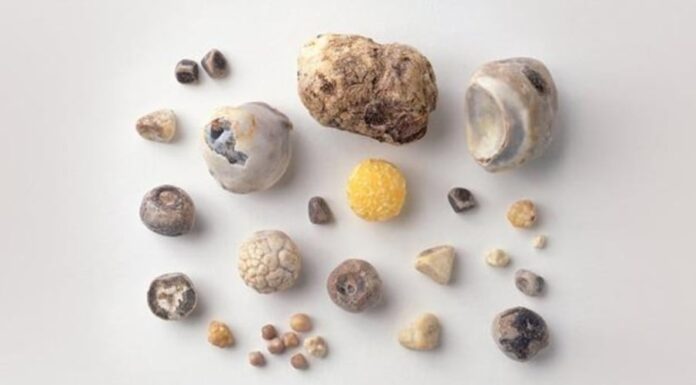 5 Key Differences Between Gallstones and Kidney Stones: Which is More Serious?