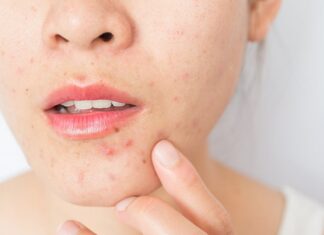 The Ultimate Guide to Acne: A Simple Home Remedy Every Girl Should Know