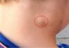 5 Early Warning Signs of Lymph Node Cancer, Number 1 is Very Obvious