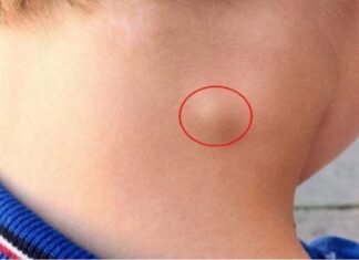 5 Early Warning Signs of Lymph Node Cancer, Number 1 is Very Obvious