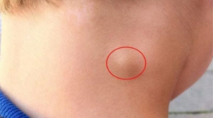5 Early Warning Signs of Lymph Node Cancer, Number 1 is Very Obvious