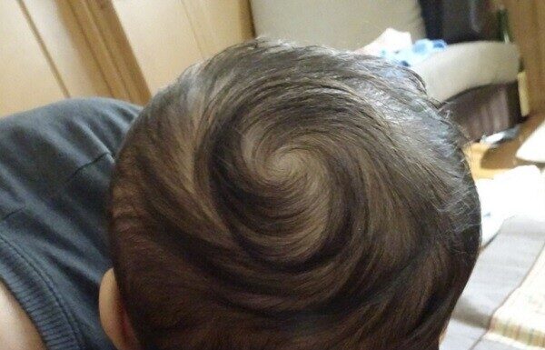 Does a Baby With More Hair Whorls Mean Higher Intelligence? Science Explains.