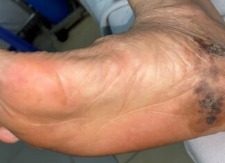 The Strange Spot on Your Skin: A Warning Sign of Aggressive Cancer You Shouldn’t Ignore!