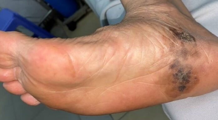 The Strange Spot on Your Skin: A Warning Sign of Aggressive Cancer You Shouldn’t Ignore!