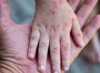 Can Measles Return After You’ve Had It?
