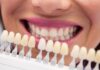 “Cosmetic Dental Veneers at Dang Luu Dental Clinic”