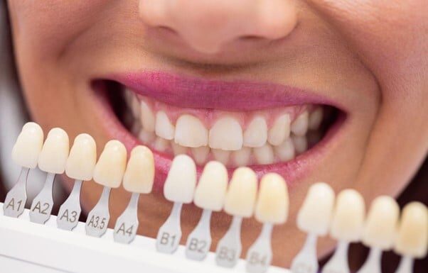 “Cosmetic Dental Veneers at Dang Luu Dental Clinic”