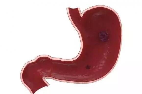 “4 Warning Signs That May Indicate Stomach Cancer: Be Vigilant and Take Action”