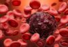 7 Silent Signs of Blood Cancer You May Be Unknowingly Ignoring