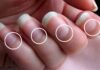 Diagnosing Health Issues Through Your Fingernails