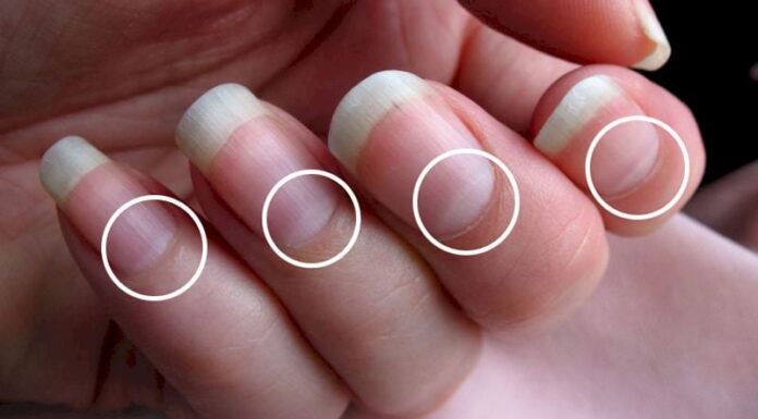 Diagnosing Health Issues Through Your Fingernails