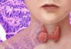 The Unsuspected Symptom: A 54-year-old Woman’s Thyroid Cancer Discovery.