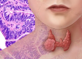 The Unsuspected Symptom: A 54-year-old Woman’s Thyroid Cancer Discovery.