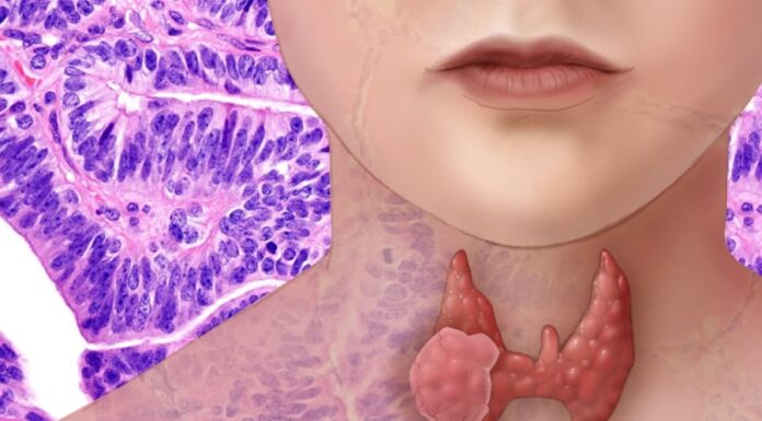 The Unsuspected Symptom: A 54-year-old Woman’s Thyroid Cancer Discovery.