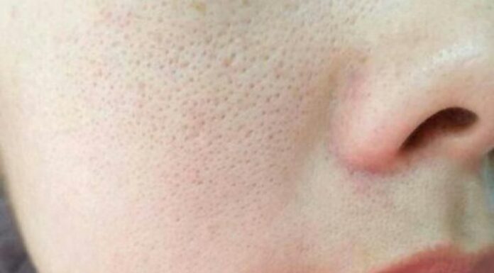 Unveiling Nature’s Secrets to Tighten Enlarged Facial Pores