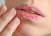 Rescue Your Lips: Simple Tips to Heal Dry, Flaky Lips