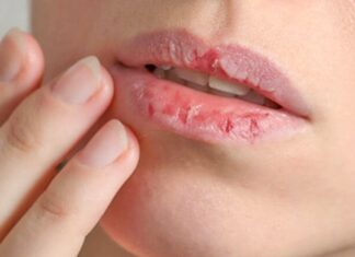 Rescue Your Lips: Simple Tips to Heal Dry, Chapped Lips