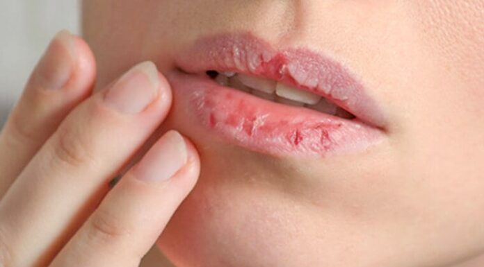 “Rescue Remedies for Chapped Lips: Simple Tips for a Supple Pout”