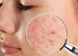 Clear Skin in Just 4 Weeks: 5 Simple Changes That Work Wonders